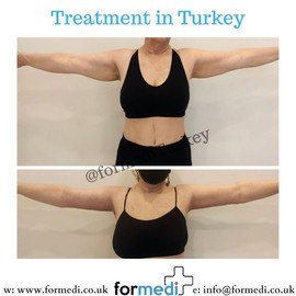 Arm Lift Surgery at formedi