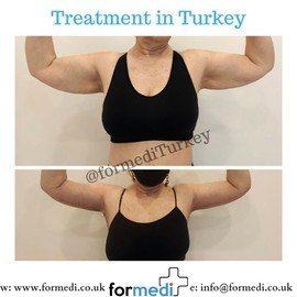 Arm Lift Surgery at formedi