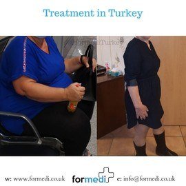 Gastric Sleeve Surgery