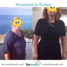 Gastric Sleeve Surgery