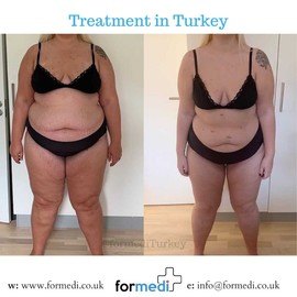 Gastric Sleeve Surgery