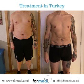 Gastric Sleeve Surgery