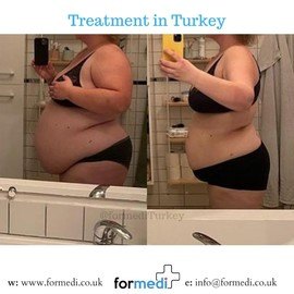 Gastric Sleeve Surgery