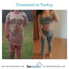 Gastric Sleeve Surgery