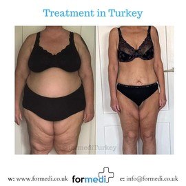 Gastric Sleeve Surgery