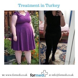 Gastric Sleeve Surgery