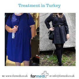Gastric Sleeve Surgery