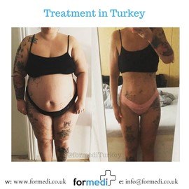 Gastric Sleeve Surgery