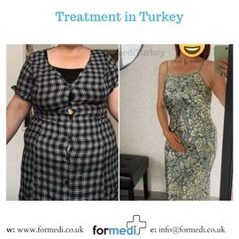 Gastric Sleeve Surgery