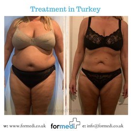 Gastric Sleeve Surgery