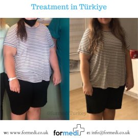 Gastric Sleeve Surgery