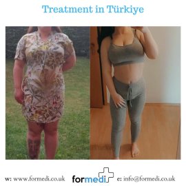 Gastric Sleeve Surgery