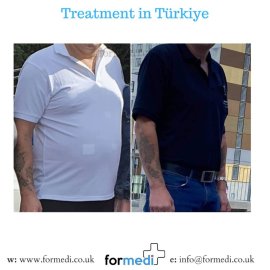 Gastric Sleeve Surgery