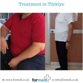 Gastric Sleeve Surgery