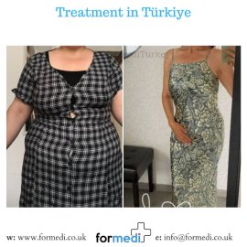 Gastric Sleeve Surgery