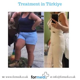 Gastric Sleeve Surgery