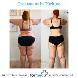 Gastric Sleeve Surgery