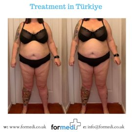 Gastric Sleeve Surgery