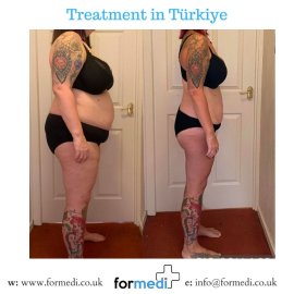 Gastric Sleeve Surgery