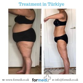 Gastric Sleeve Surgery