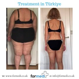 Gastric Sleeve Surgery