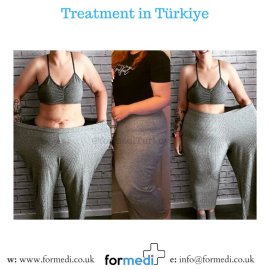 Gastric Sleeve Surgery