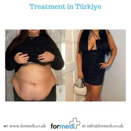 Gastric Sleeve Surgery