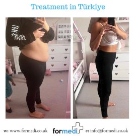 Gastric Sleeve Surgery