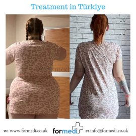 Gastric Sleeve Surgery