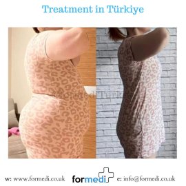 Gastric Sleeve Surgery