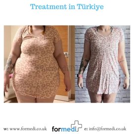 Gastric Sleeve Surgery