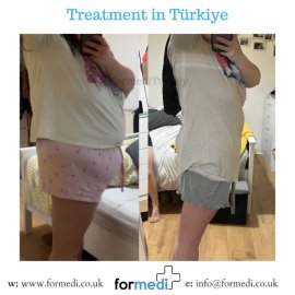 Gastric Sleeve Surgery