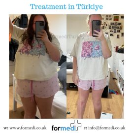 Gastric Sleeve Surgery
