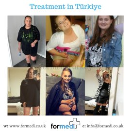 Gastric Sleeve Surgery