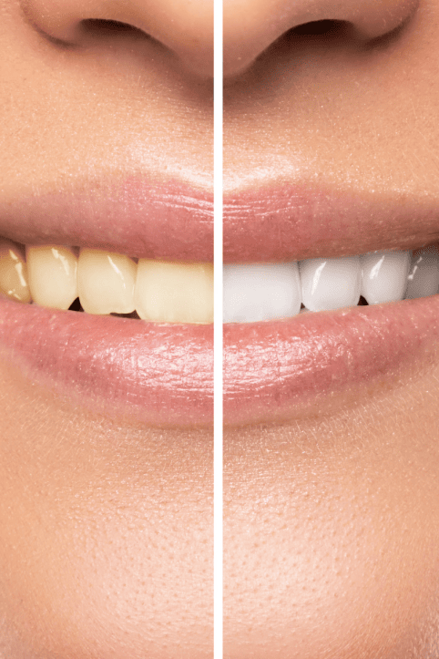 Lazerle Diş Beyazlatma