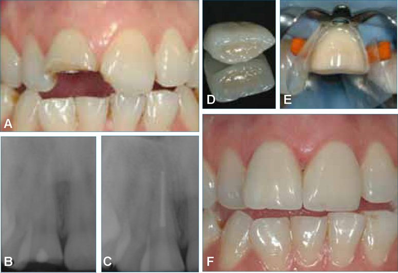 Kanal yenileme tedavisi