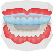 Diş Gıcırdatma ve Diş Sıkma Tedavisi