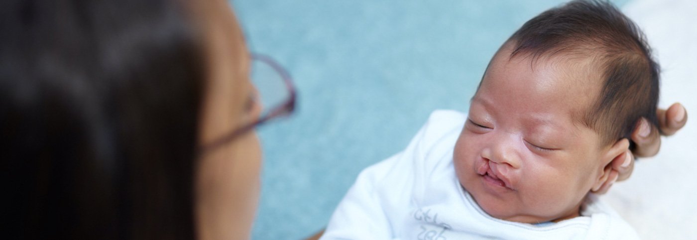 Bebek dudak yarığı