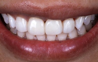 Kompozit Bonding Sonrası