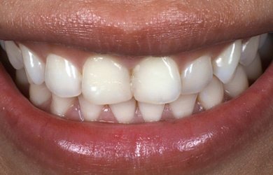 Kompozit Bonding Öncesi