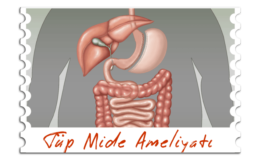 Tüp Mide Ameliyat
