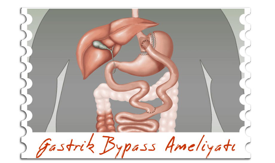 Gastric Bypass Ameliyatı