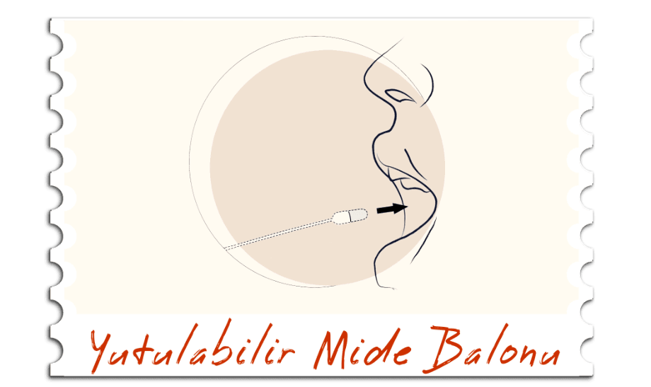 Yutulabilir Mide Balonu