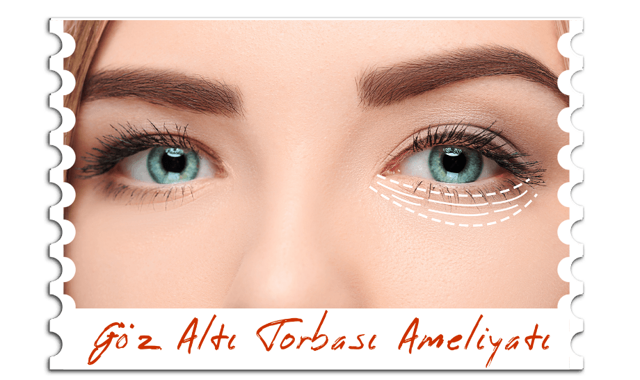 Göz Altı Torbası Ameliyatı