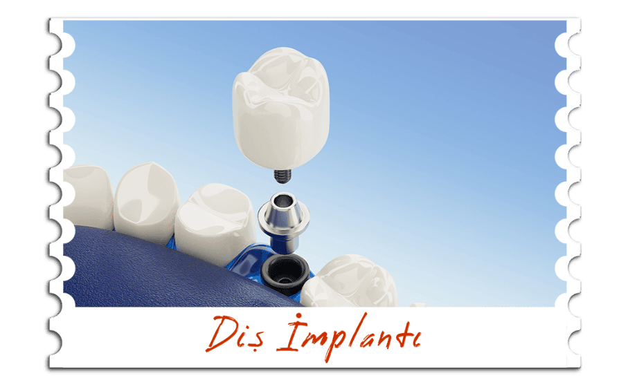 Diş İmplantı