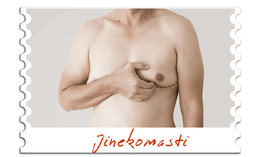Jinekomasti