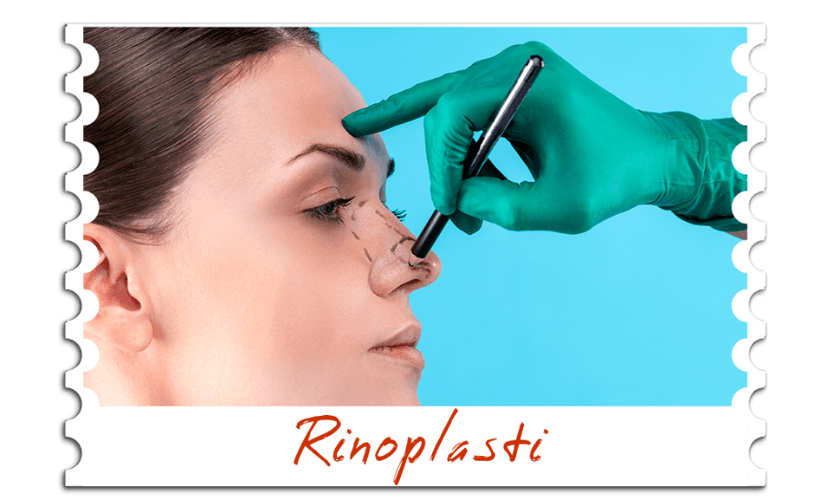 Rinoplasti