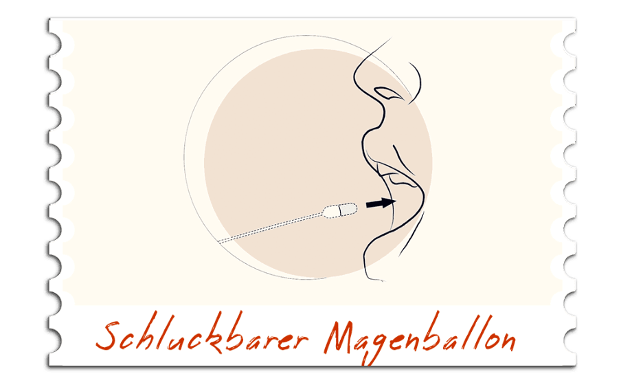 Schluckbarer Magenballon