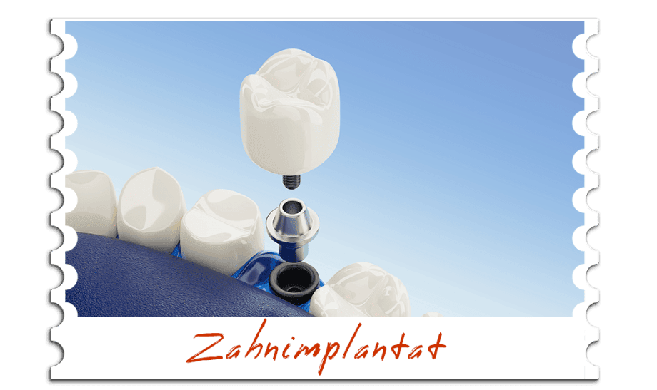 Zahnimplantat