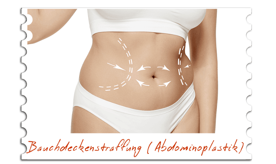 Bauchdeckenstraffung (Abdominoplastik)